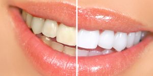 chicago teeth whitening methods why everyone has that smile on their faces