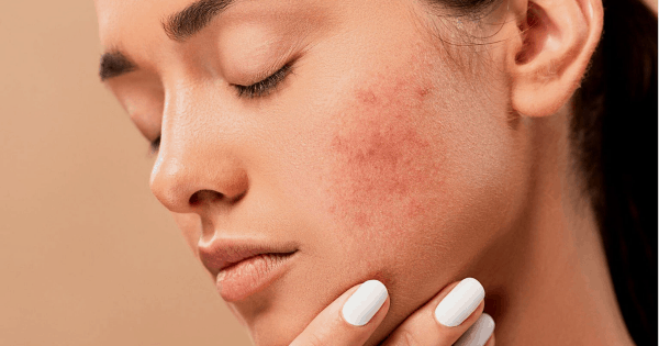 skin care treatment for the most common skin conditions