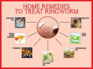 ringworm home treatment effective remedies to get rid of ringworm